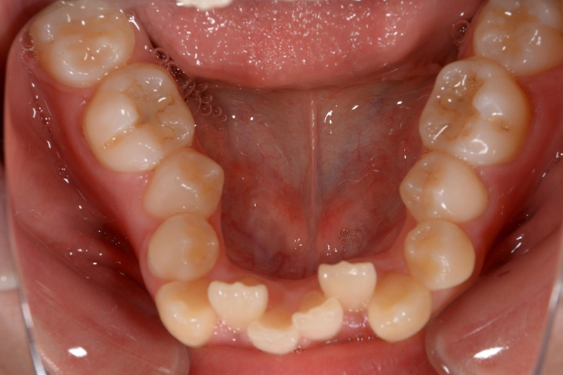ワイヤー矯正の術前の下の歯