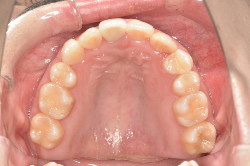 ワイヤー矯正の術後の上の歯