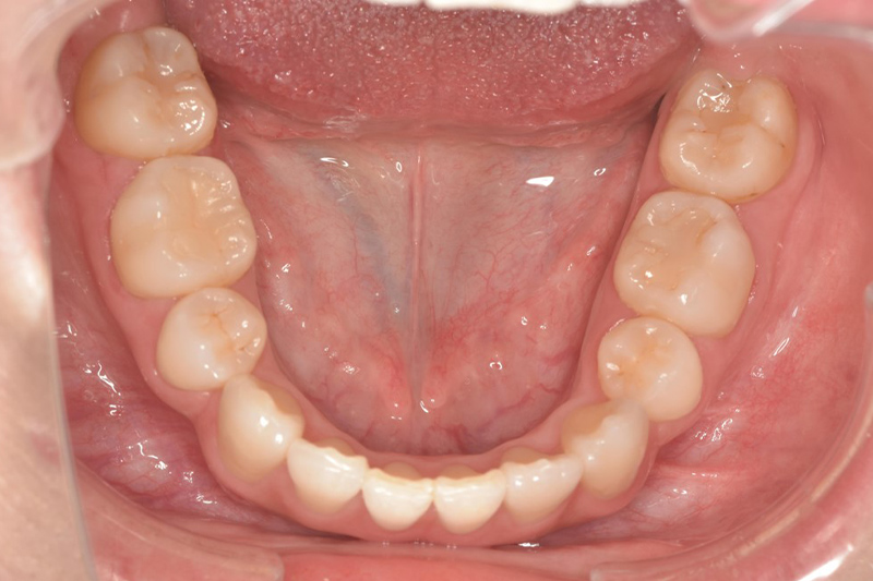 ワイヤー矯正の術後の下の歯