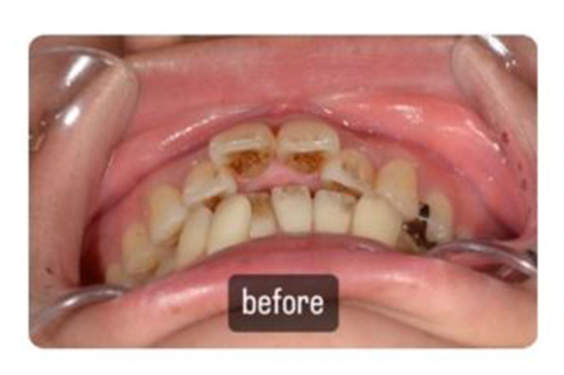 ワイヤー矯正の症例の術前