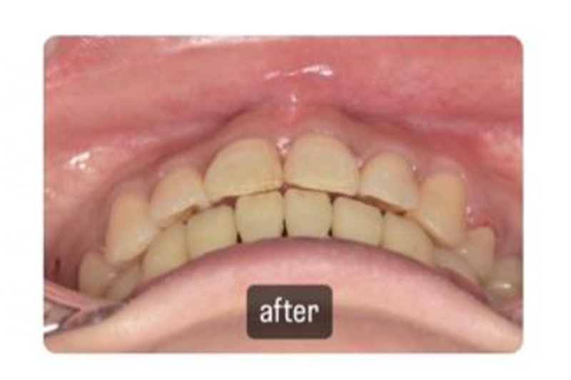 ワイヤー矯正の症例の術後