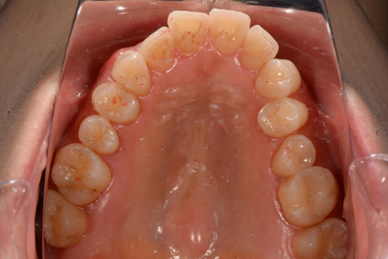 インビザラインの術前の上の歯