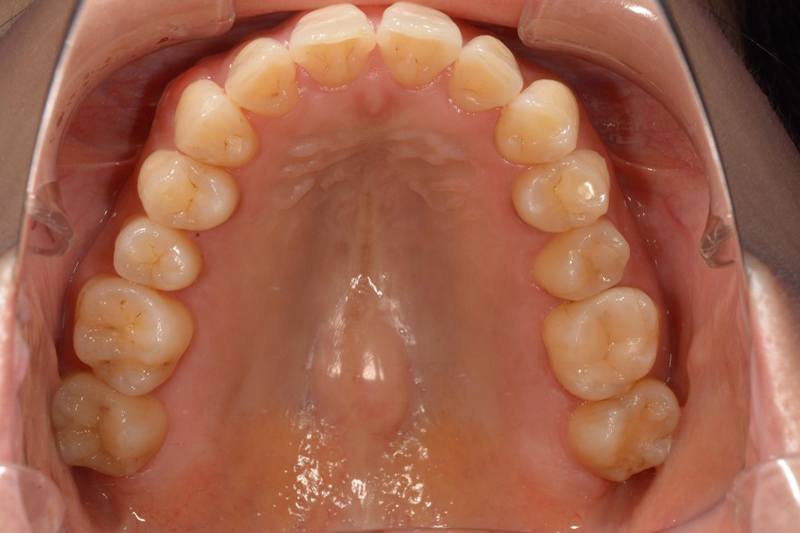 インビザラインの術後の上の歯