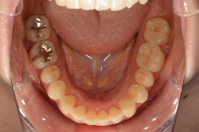 インビザラインの術後の下の歯