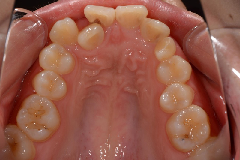 ワイヤー矯正の術前の上の歯