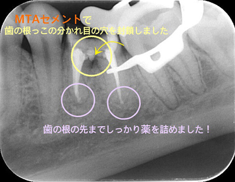 根幹処置歯における根尖部X線透過象の発現率