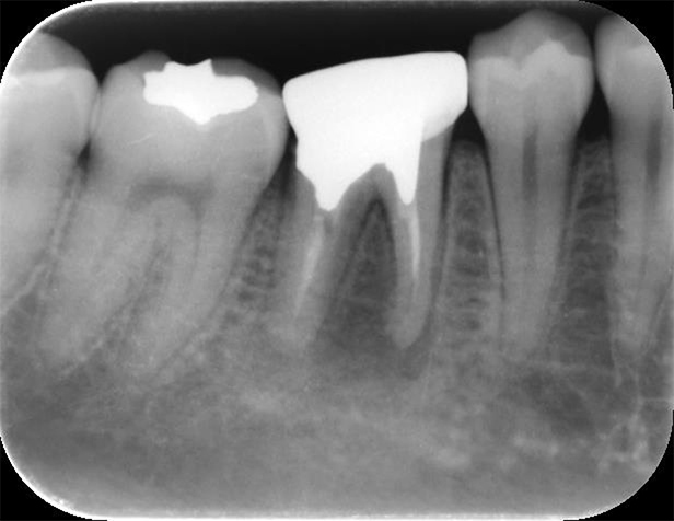 むし歯治療（根管治療）の術前