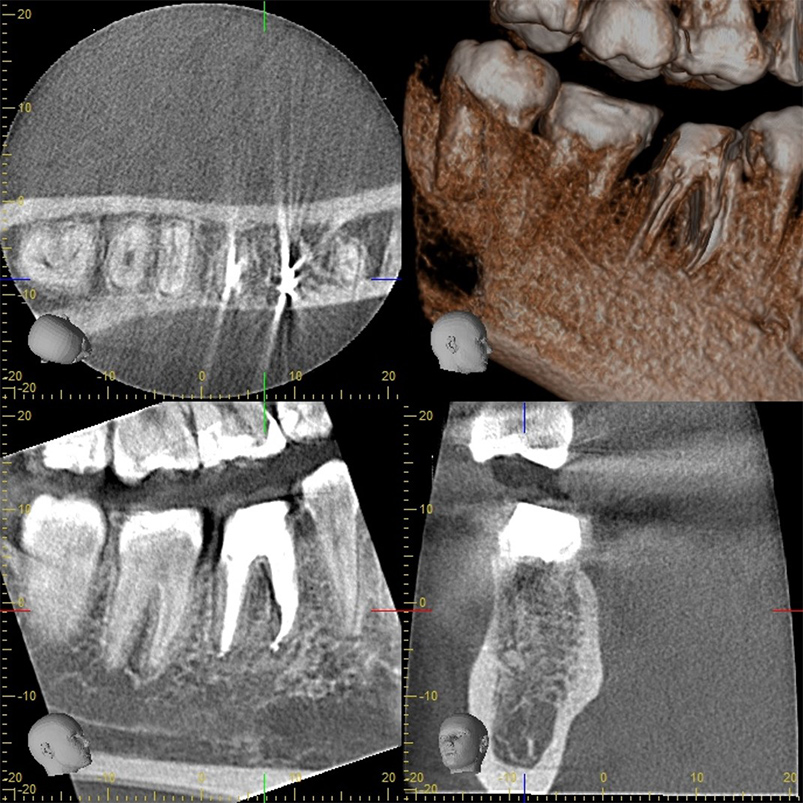 むし歯治療（根管治療）の術後全体画像