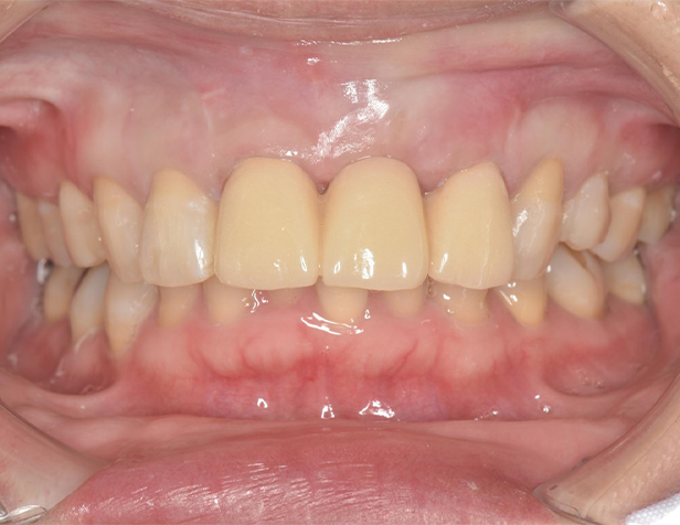 オールセラミックブリッジの症例　術前の上下の歯