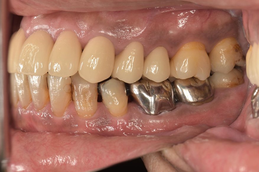 審美治療（オールセラミックス）の症例　術後の上下の歯