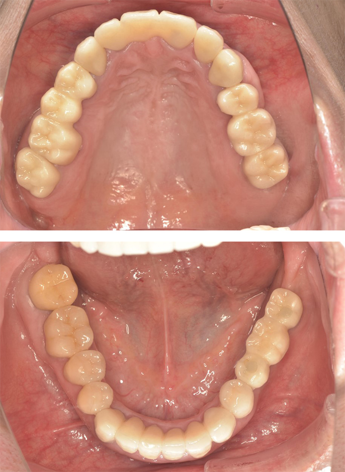 インプラントを組み合わせた全体治療　術後の上下の歯