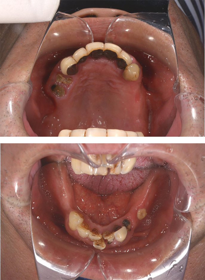 インプラントとデンチャーを組み合わせた治療　術前の上下の歯