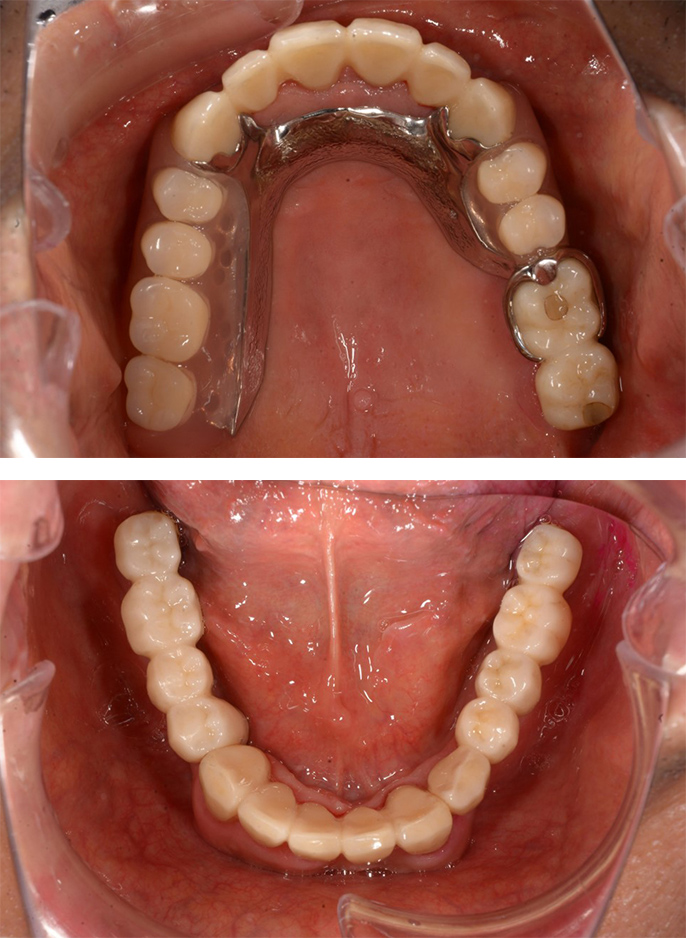 インプラントとデンチャーを組み合わせた治療　術後の上下の歯