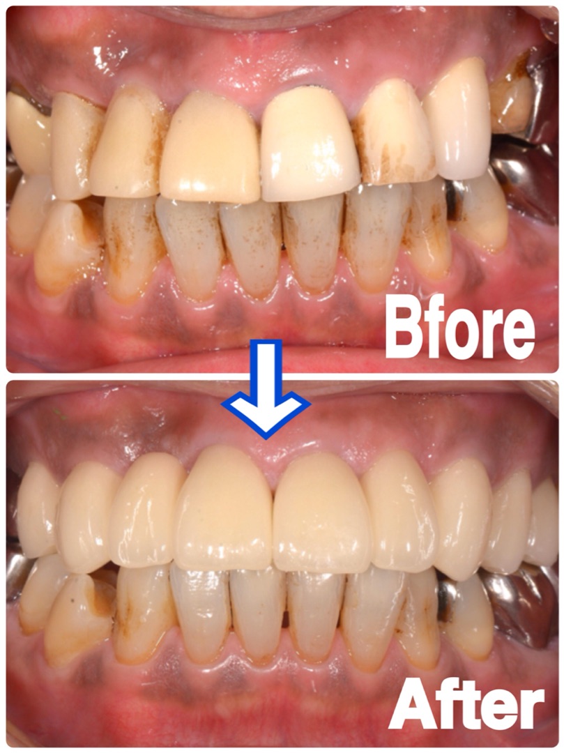 前歯のオールセラミックについて | 大阪市の歯医者なら松川デンタル