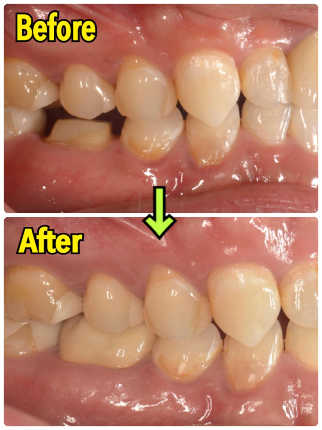 歯肉の手術〜セラミックが入るまで | 大阪市の歯医者なら松川デンタル