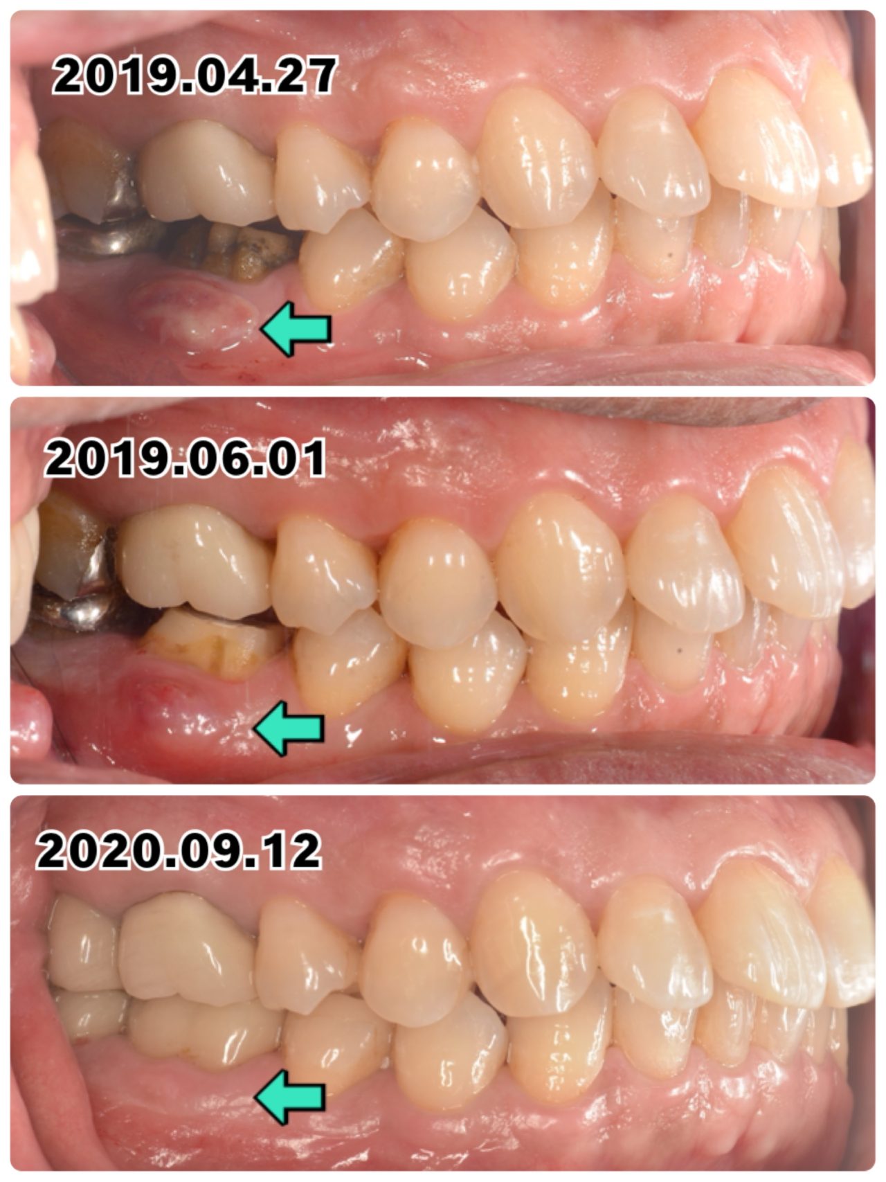 治療後歯茎の腫れ: 根管治療後 歯茎 腫れ いつまで – NMVCP
