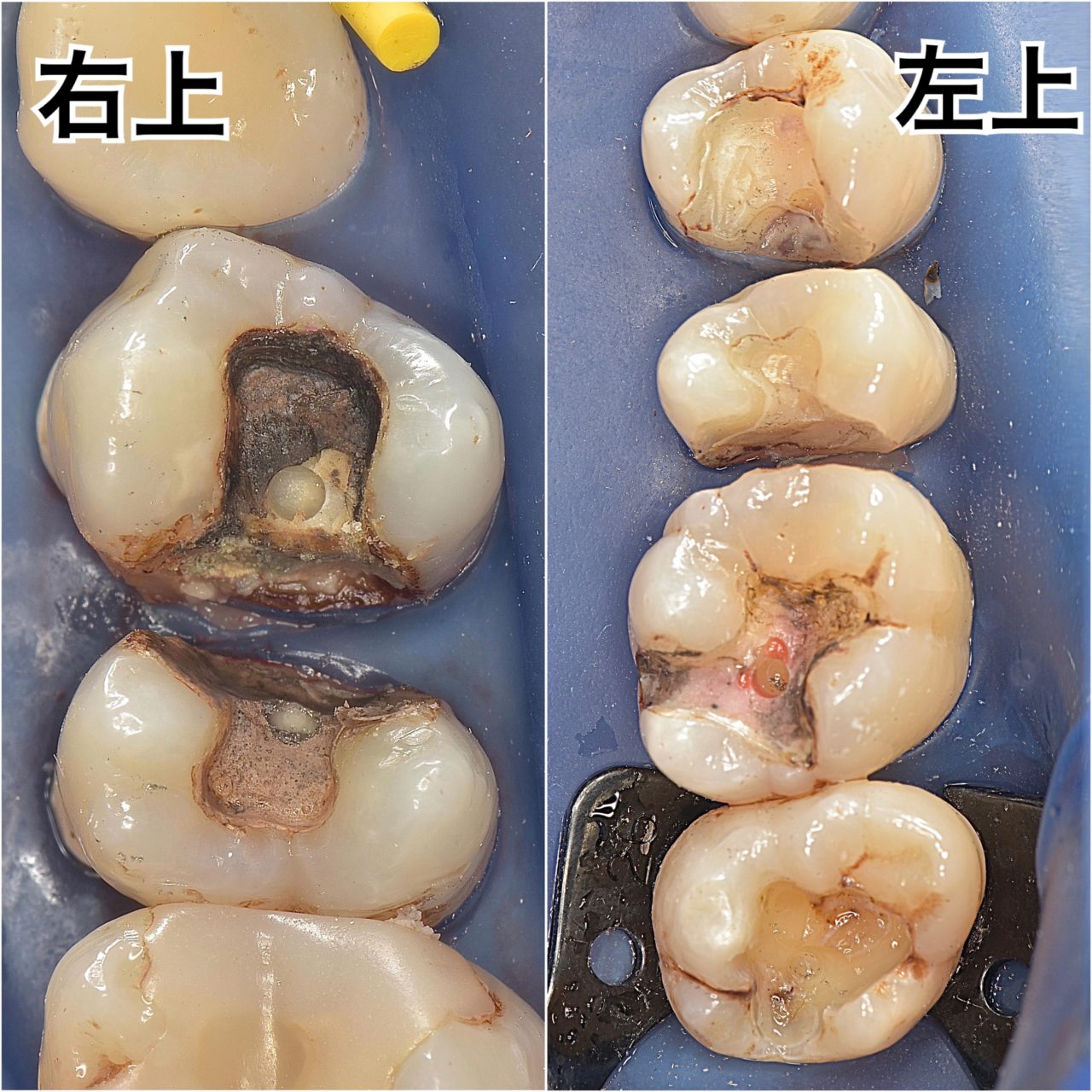 金属の詰め物が気になる患者さん｜松川デンタルオフィス