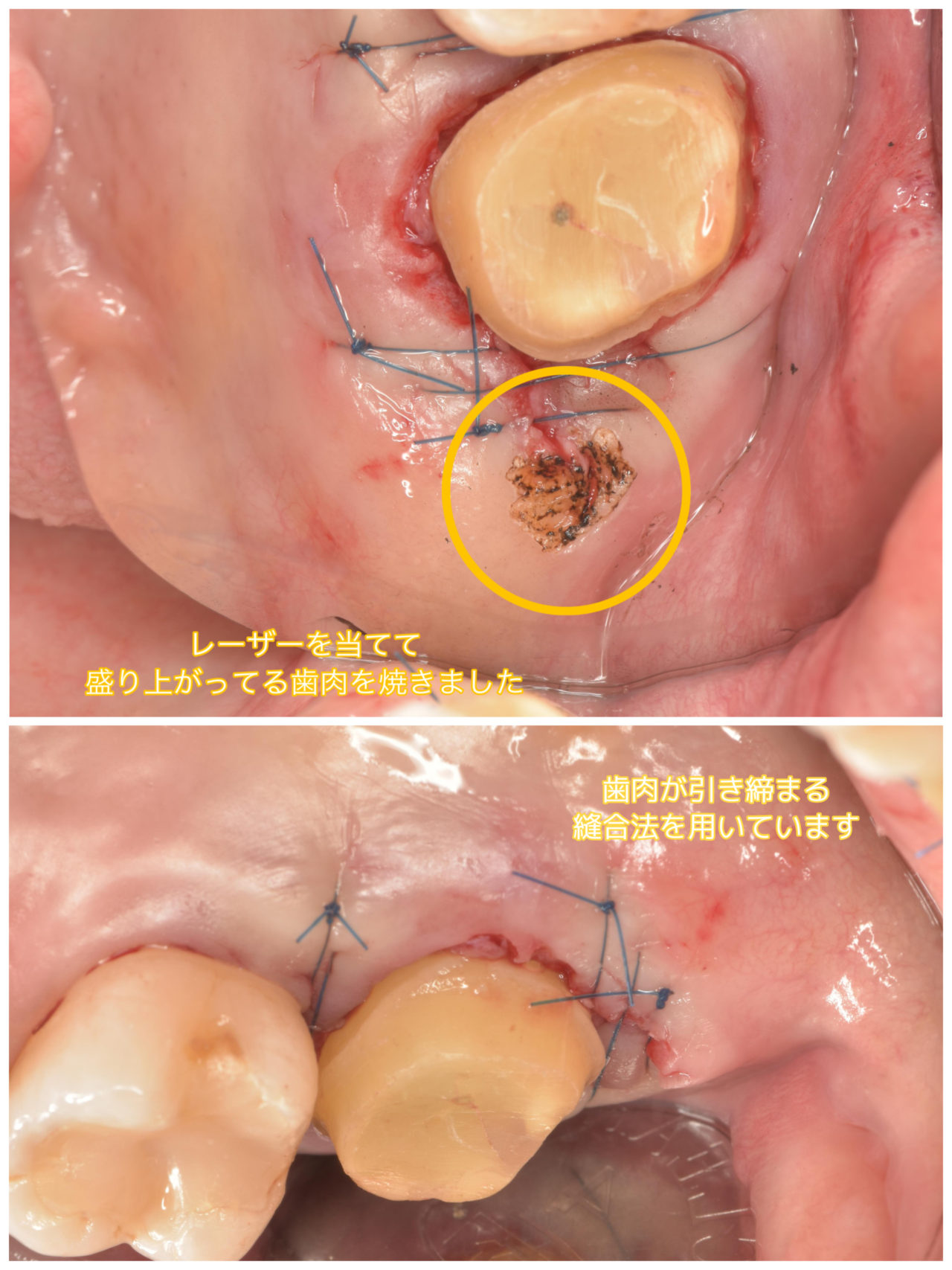 虫歯 副 鼻腔 炎