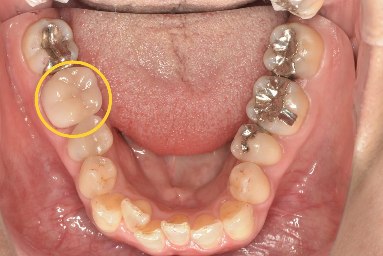 症例1:治療完了6ヶ月後の骨回復が確認できるレントゲン