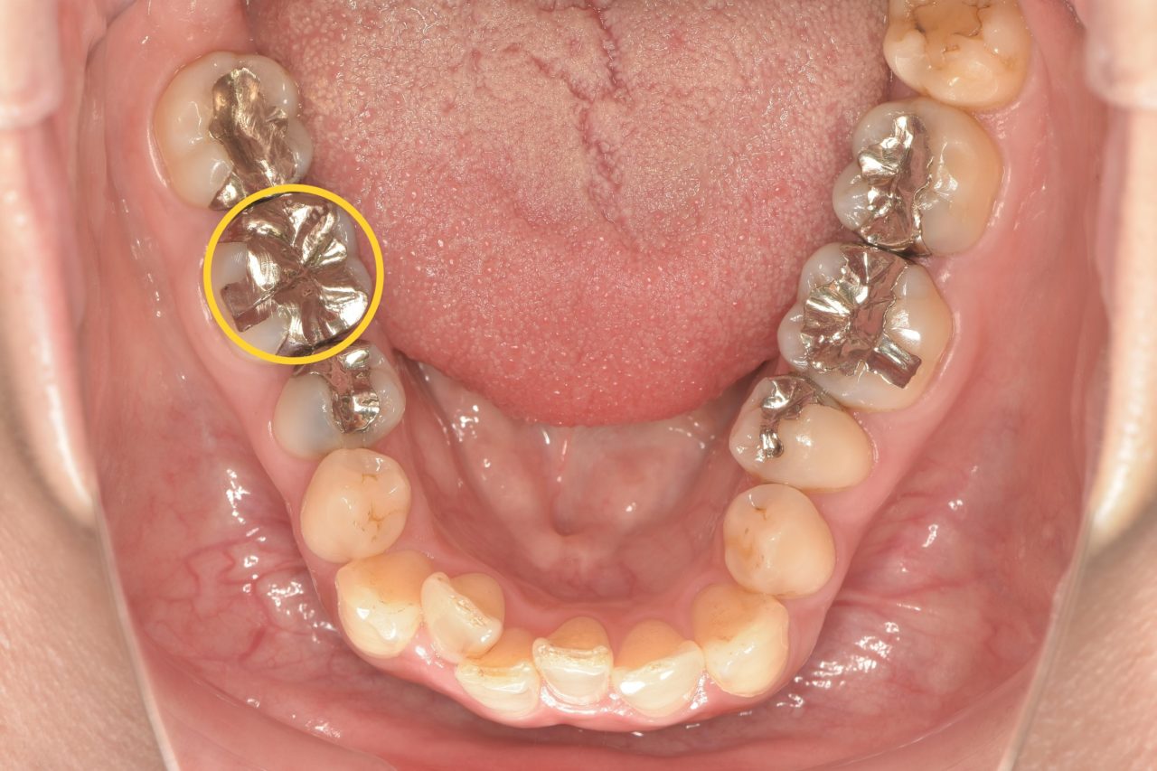 症例1:治療前のデンタルレントゲン写真