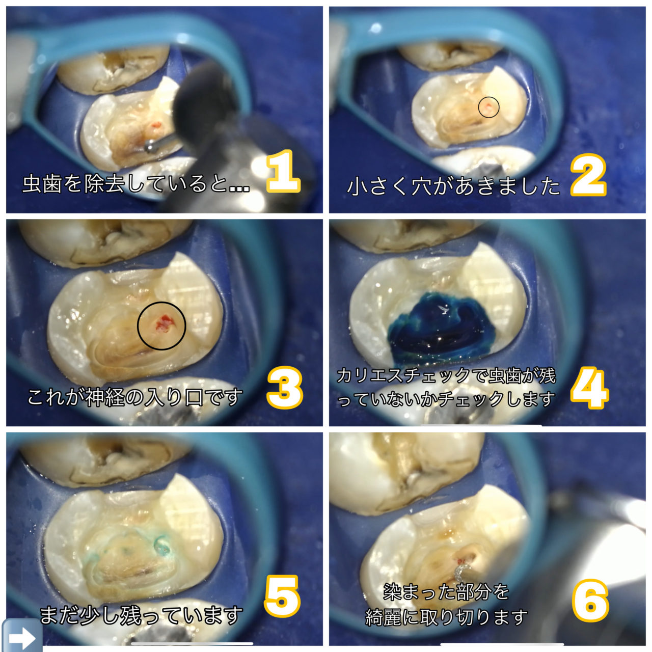失敗しない歯髄保存療法 : 抜髄する前にもう一度歯髄診断をしよう 失敗しない歯髄保存療法―抜髄する前にもう一度歯髄診断をしよう