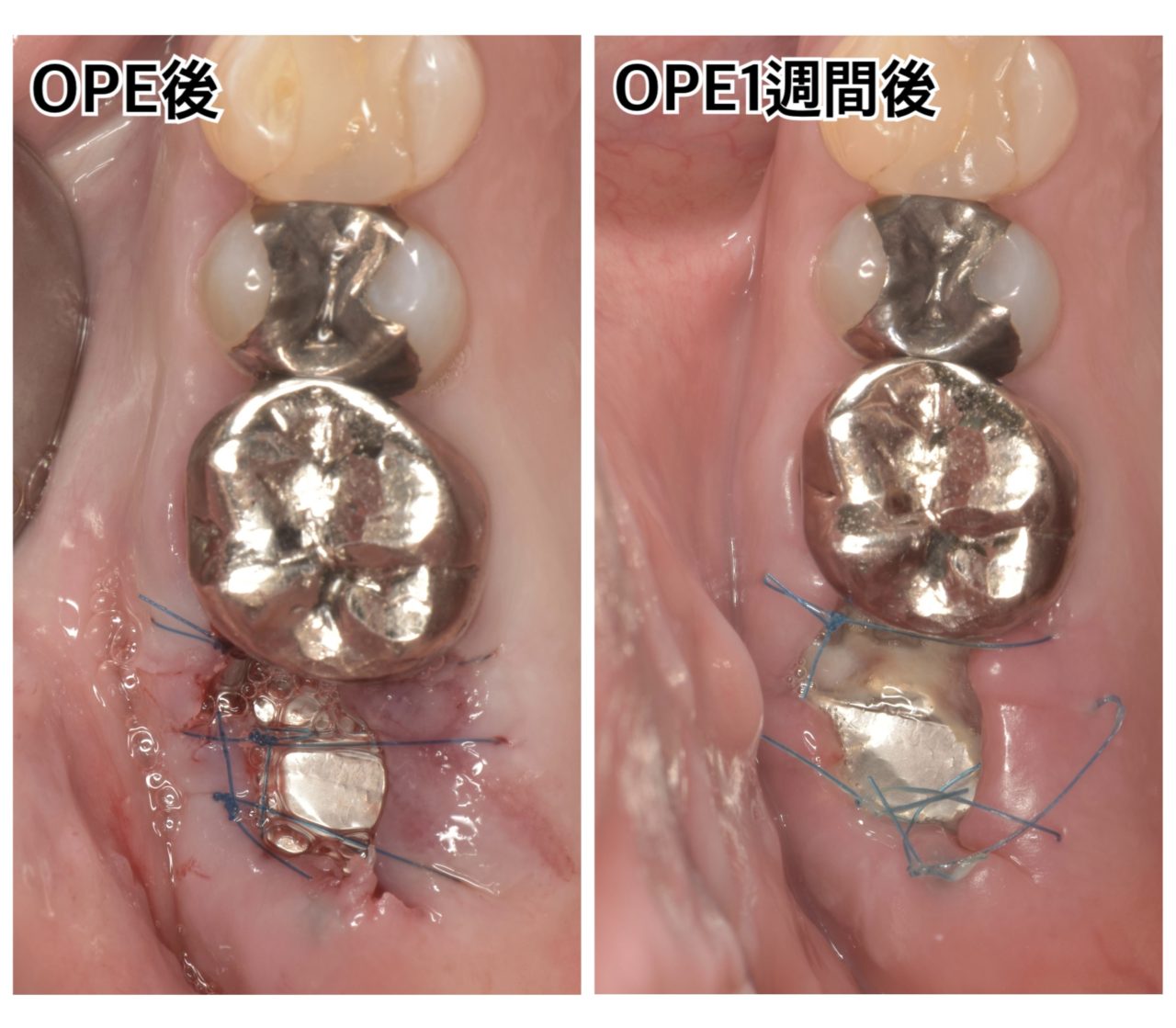 ソケットプリザベーションとは？｜松川デンタルオフィス