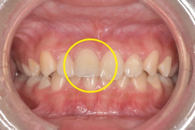 治療前の口腔内の画像