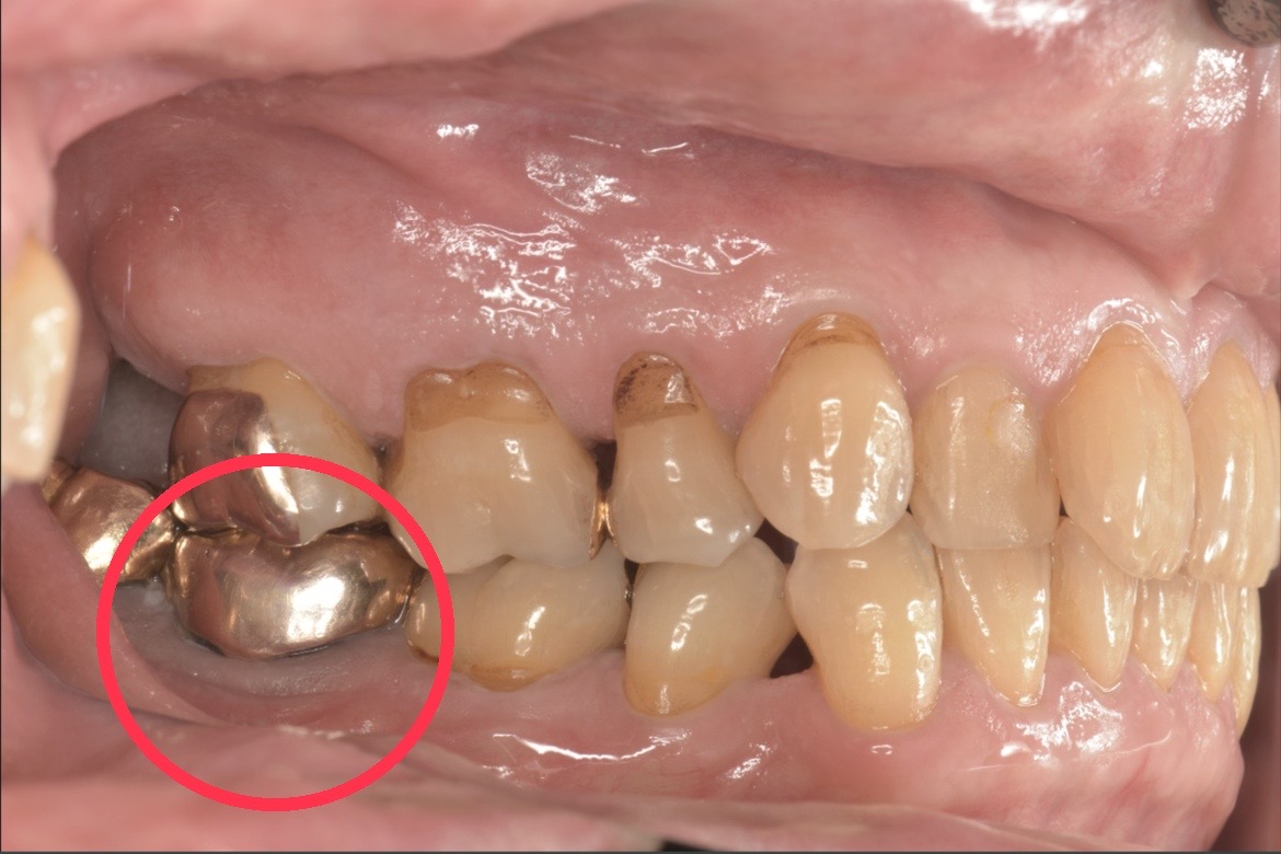 症例2:破折リーマーが残っている状態の奥歯の口内写真