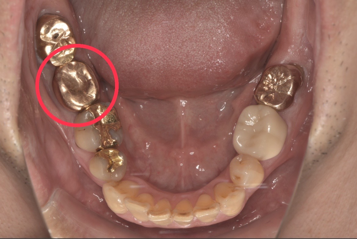 症例2:他院治療でリーマーが折れた奥歯の口内写真(初診時)