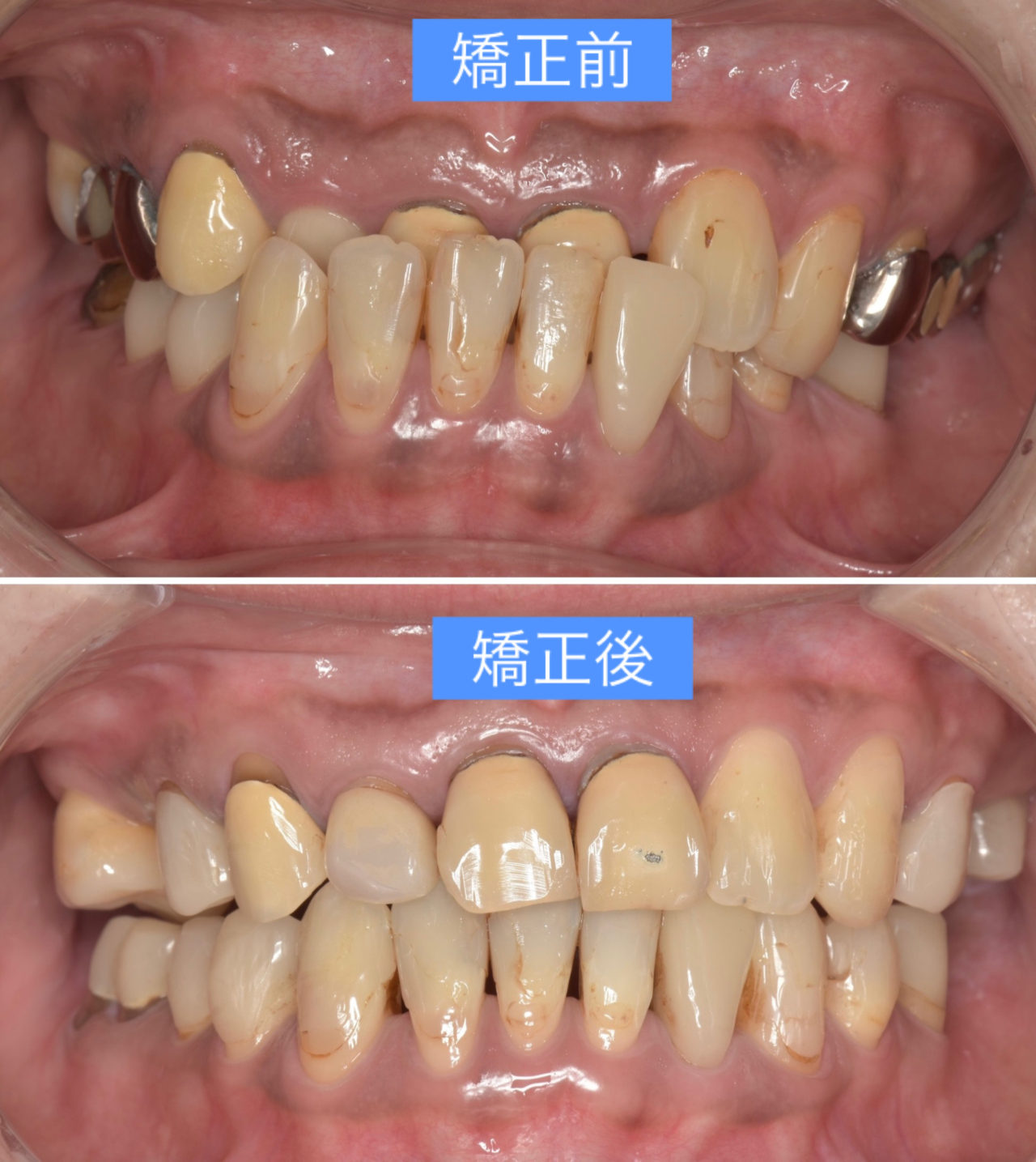 咬合不正で歯を失ってしまった患者様 | 大阪市の歯医者なら松川