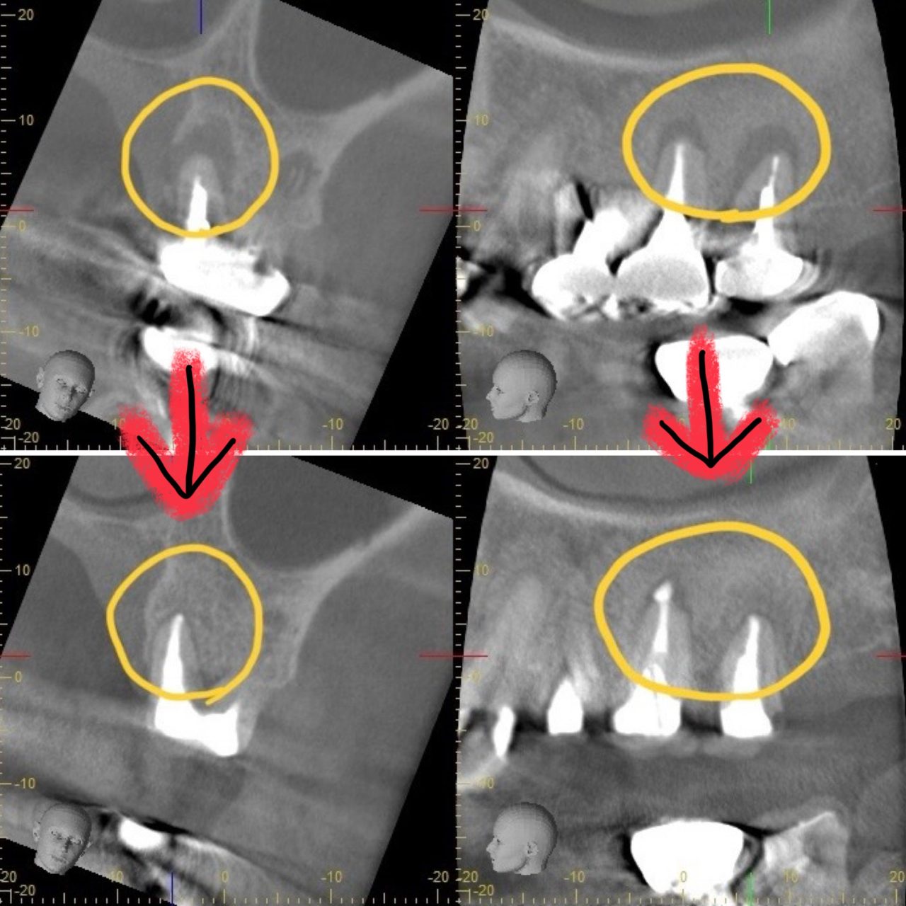 症例4:根管治療後の写真で骨吸収が治っているのが確認できる