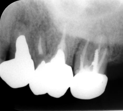 症例4:根管治療前のレントゲンで骨吸収が確認できる