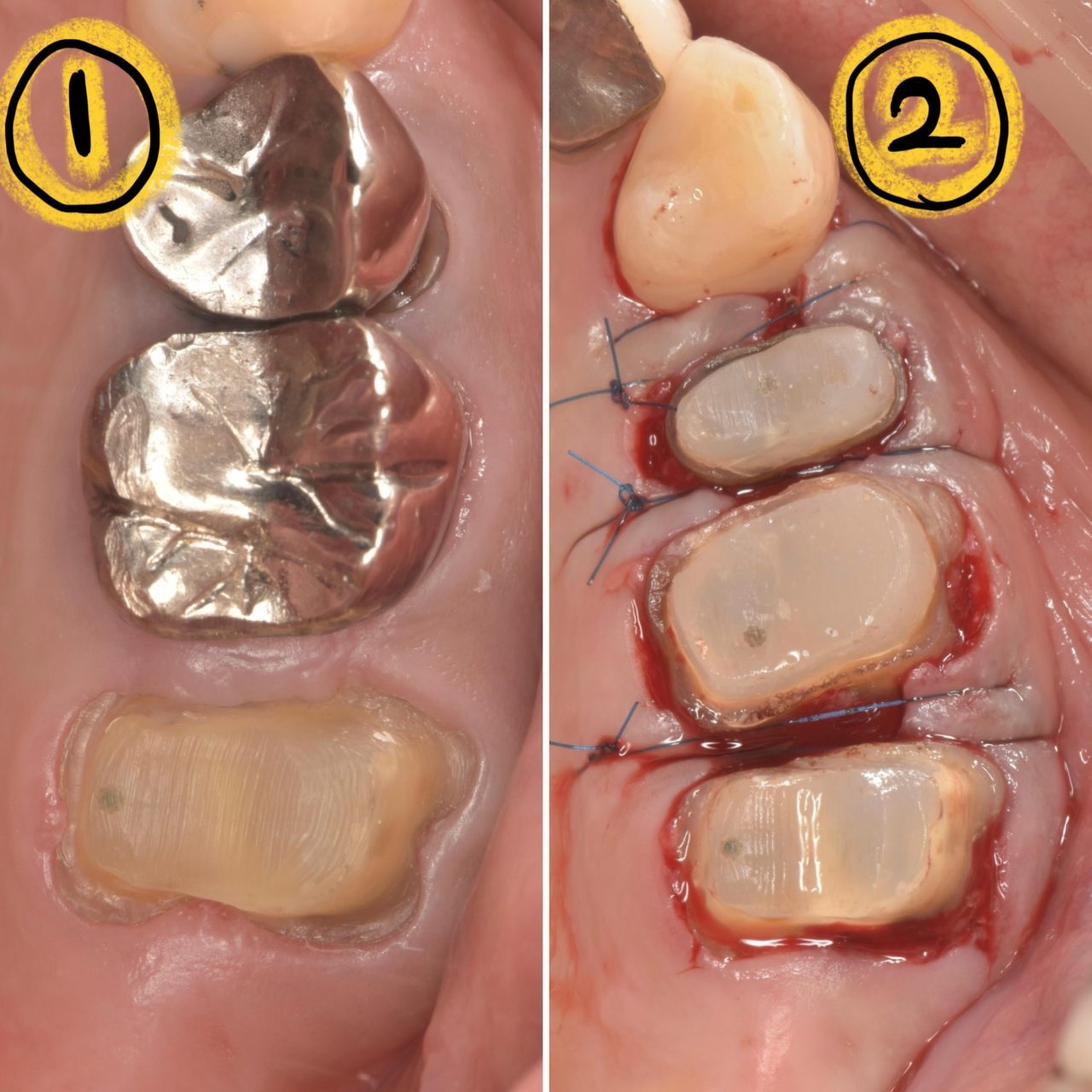 症例4:歯冠長延長術の治療前と後が確認できる