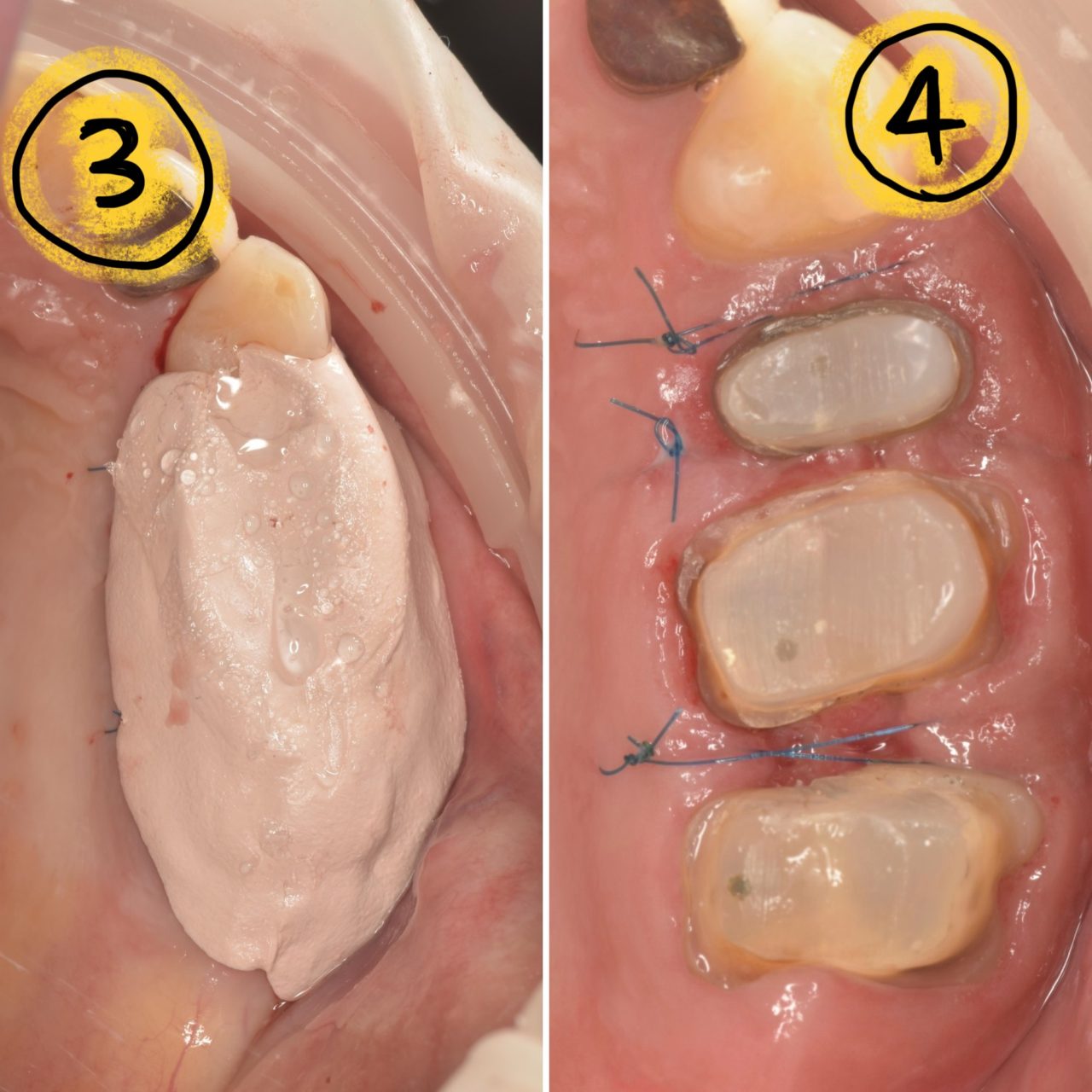症例4:歯冠長延長術の縫合後と術後1週間の状態が確認できる