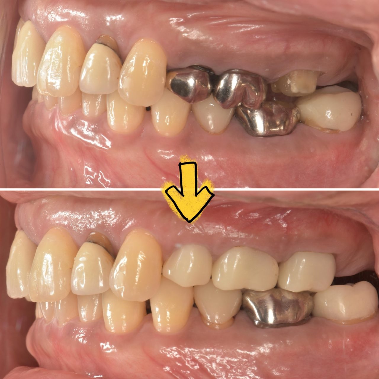 症例4:治療後半年の経過が確認でき歯茎もきれいになっている
