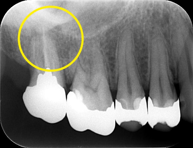 症例6:根管治療前のレントゲンで奥歯の根の先に病変が確認できる