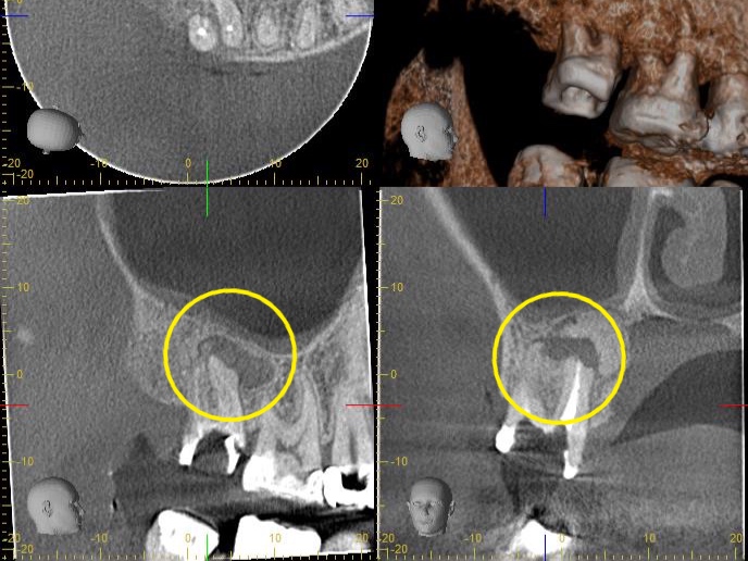 症例6:根管治療前のCT画像で病変がよりはっきりと確認できる