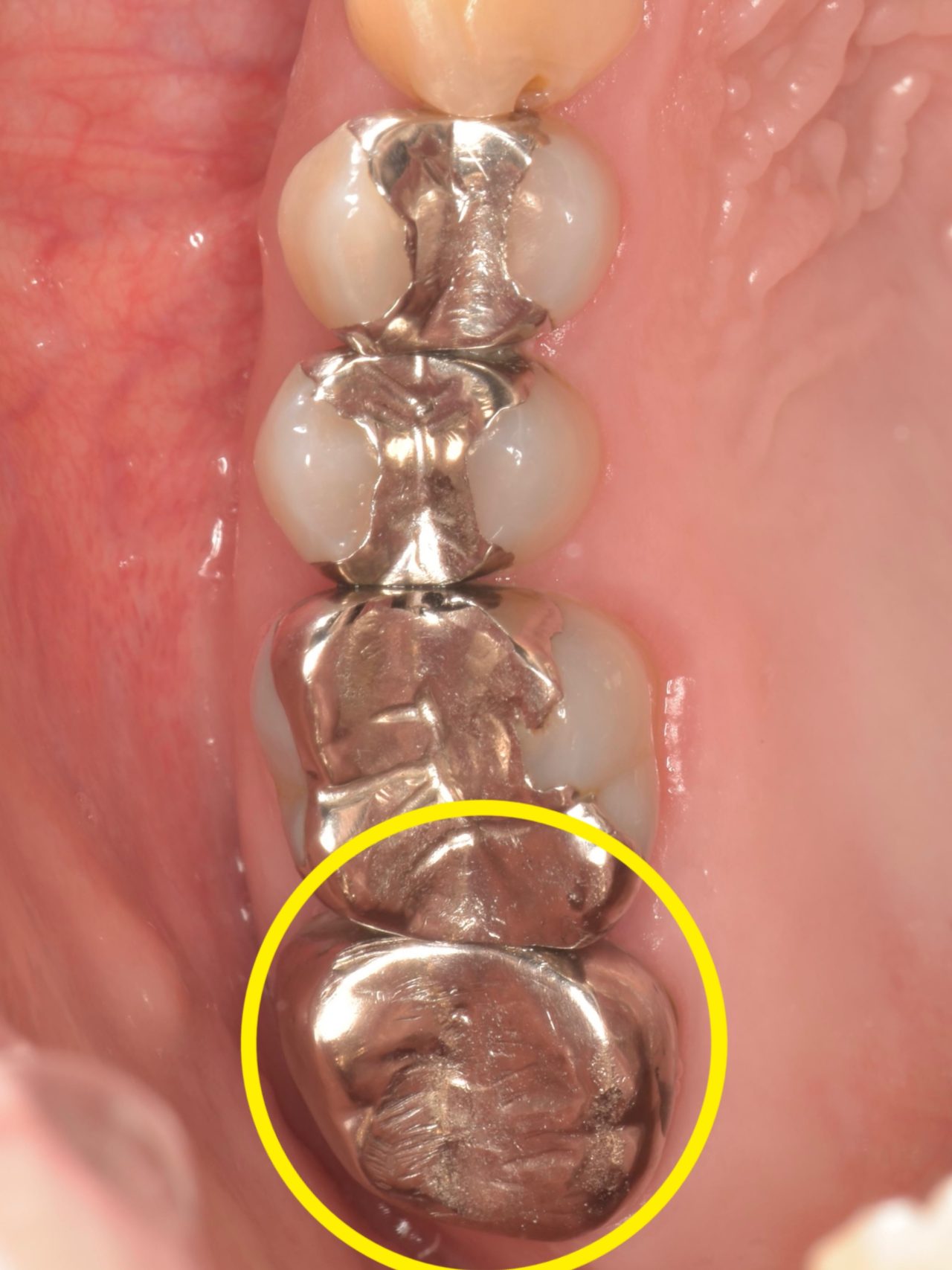 症例6:治療前の口腔内写真(銀歯が入っている箇所)