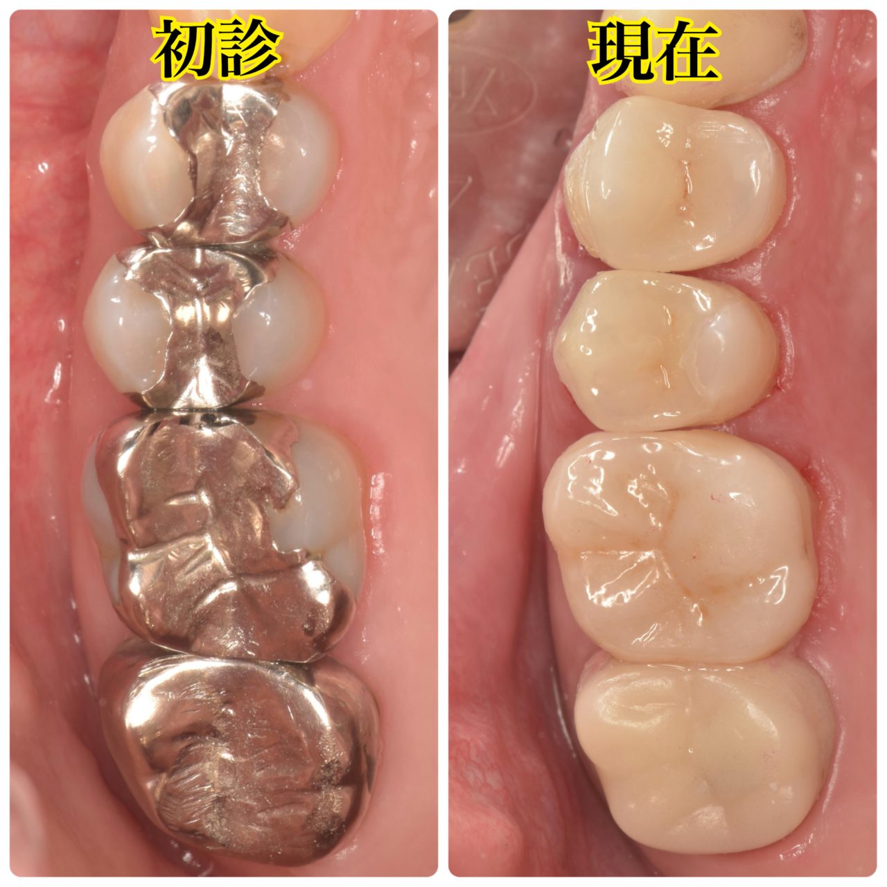症例6:治療後の口腔内写真。セラミックスの詰め物をした箇所が確認できる