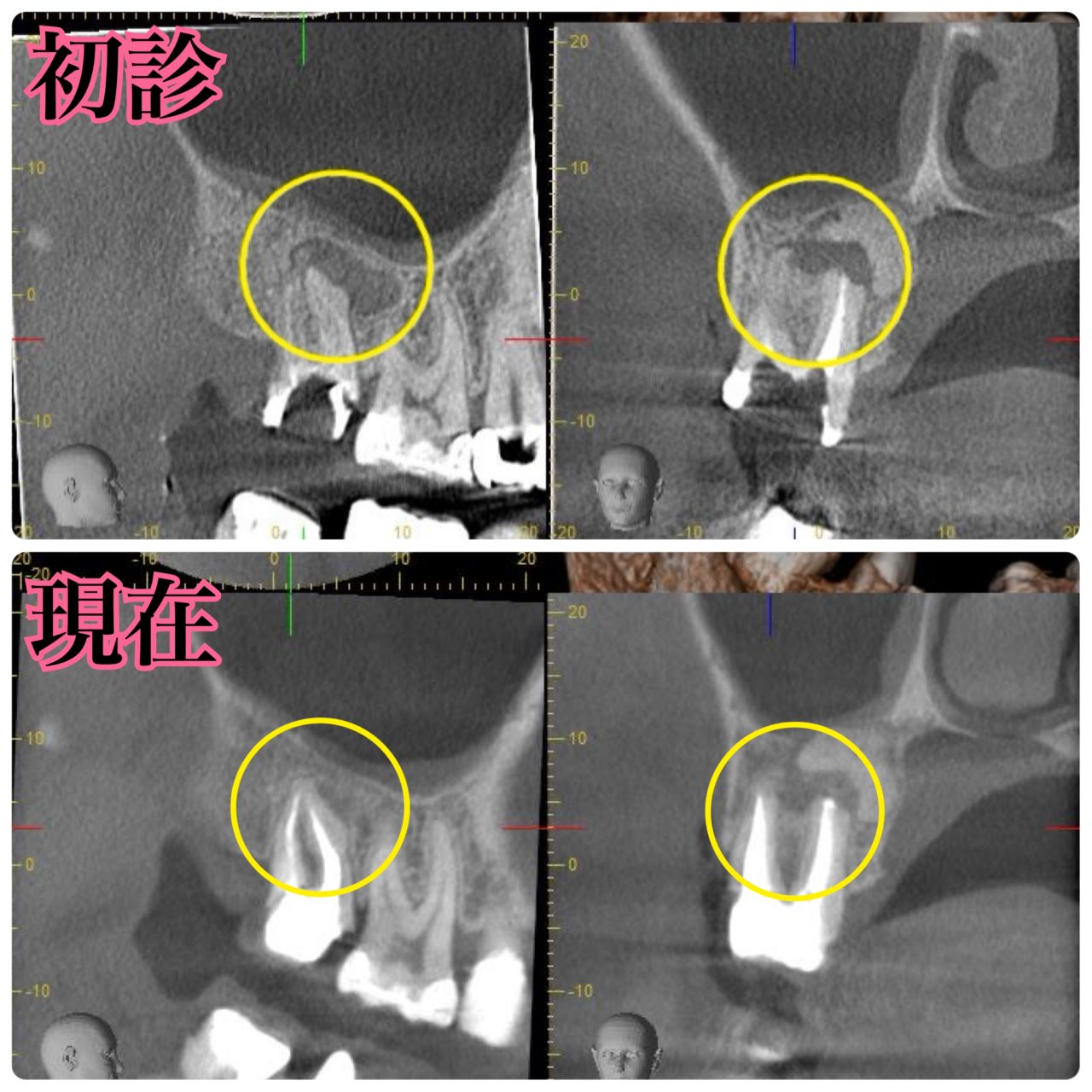 症例6:根管治療後、根尖病変がなくなったCT写真