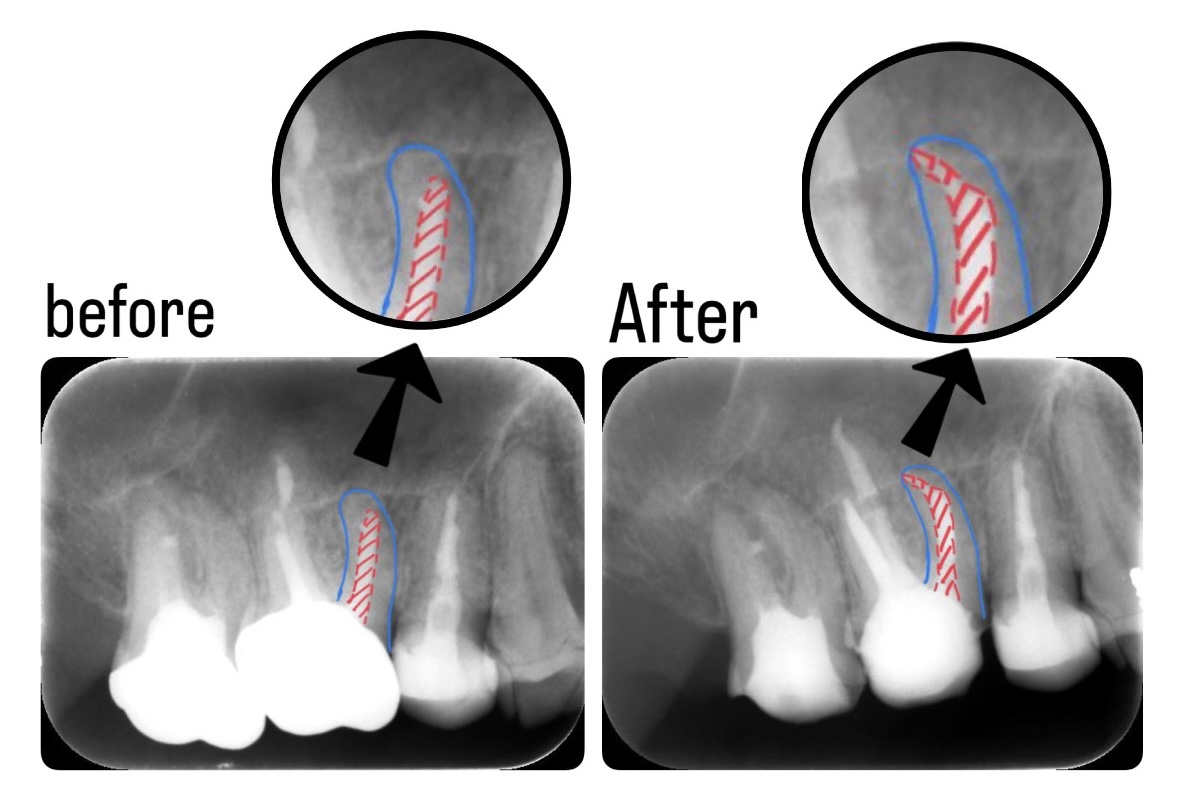 症例】過去の根管治療後にできた根尖病変を精密再治療で改善｜松川
