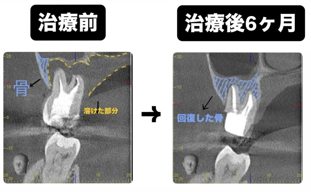過去に根管治療を行ったが、歯茎に出来物ができた患者さま | 大阪市の