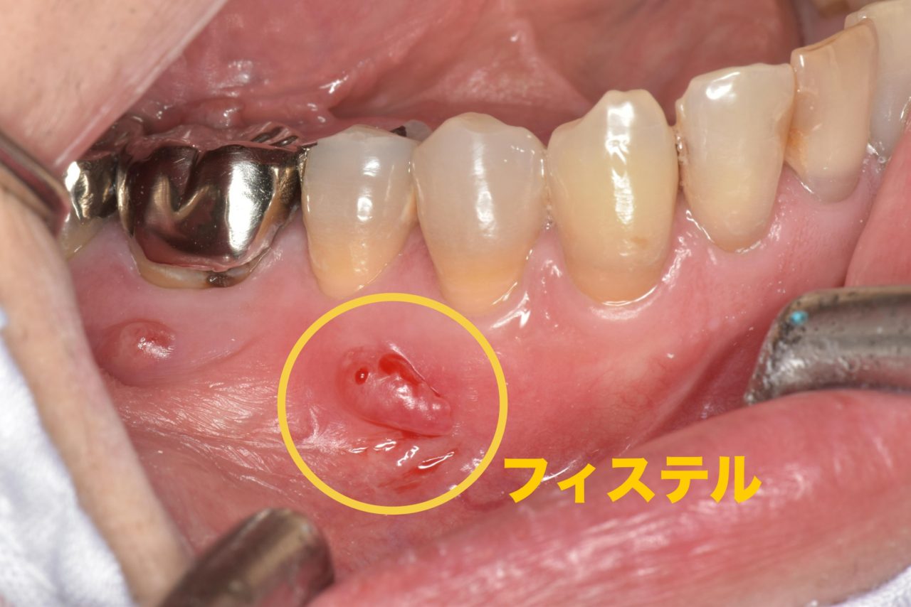 症例3:口内写真でフィステルが確認できる