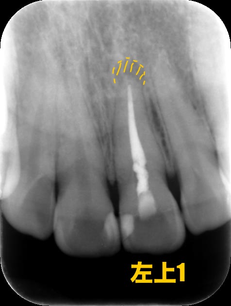 症例5:根管治療前のレントゲンで膿が確認できる