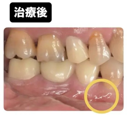 症例3:詰め物の下の歯茎に出来物ができた患者様の症例 術後