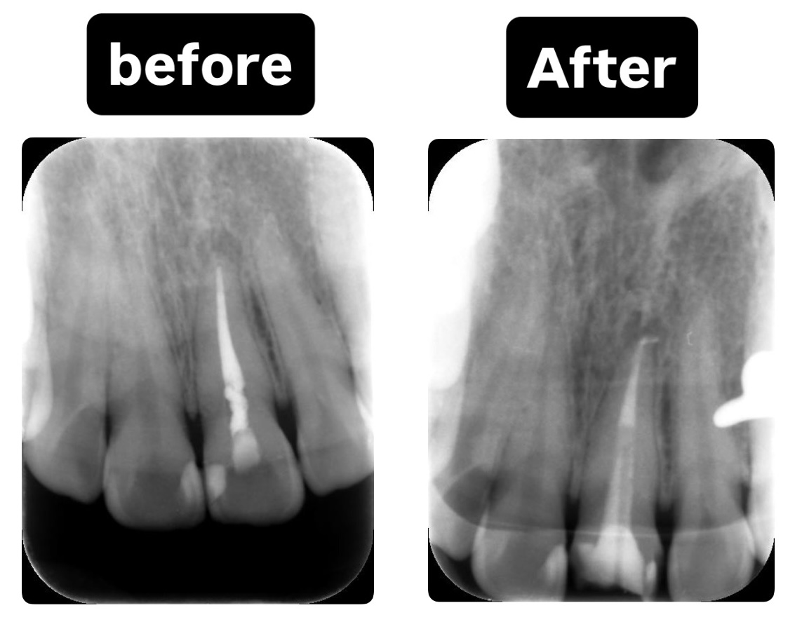 症例5:根管治療のビフォーアフターの画像で膿がなくなったこと確認できる