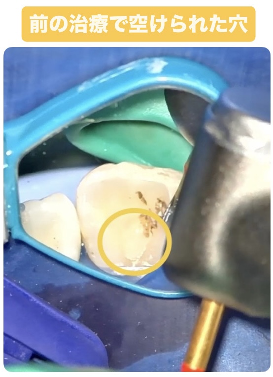 症例5:神経が通る解剖学的構造と他院の治療跡