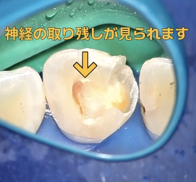 症例5:他院の治療で神経の取り残しが確認できる