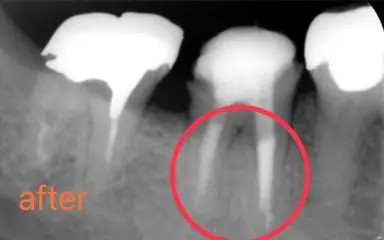 症例2:根管治療でリーマーが折れてしまった症例 術後