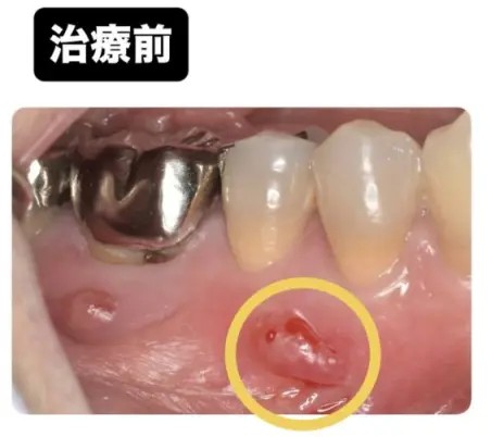 症例3:詰め物の下の歯茎に出来物ができた患者様の症例 術前